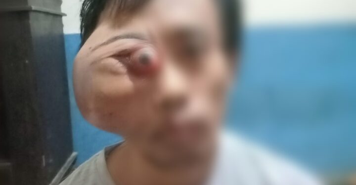 Warga Subang Derita Tumor Harap Kemurahan Hati Dermawan
